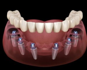 Bảng giá trồng răng implant mới nhất 2023
