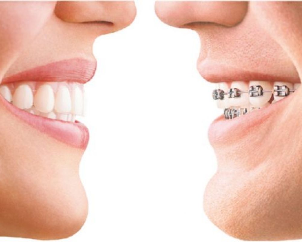 Các bước trong quy trình niềng răng Invisalign