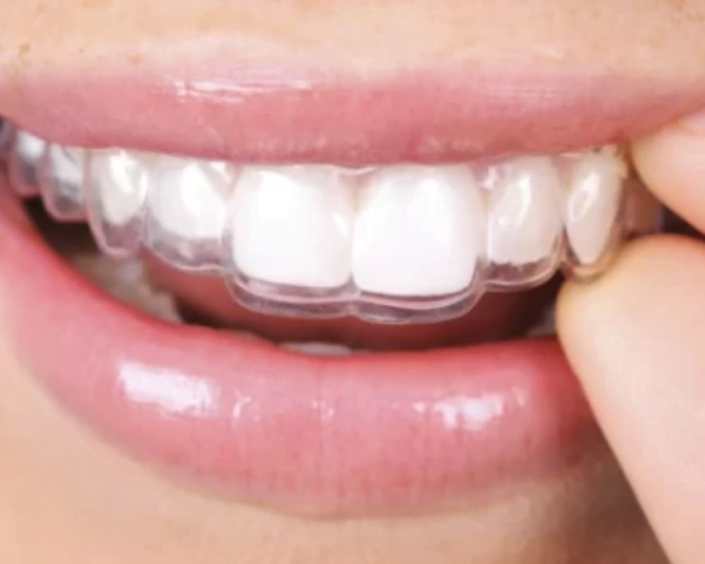Các bước trong quy trình niềng răng Invisalign