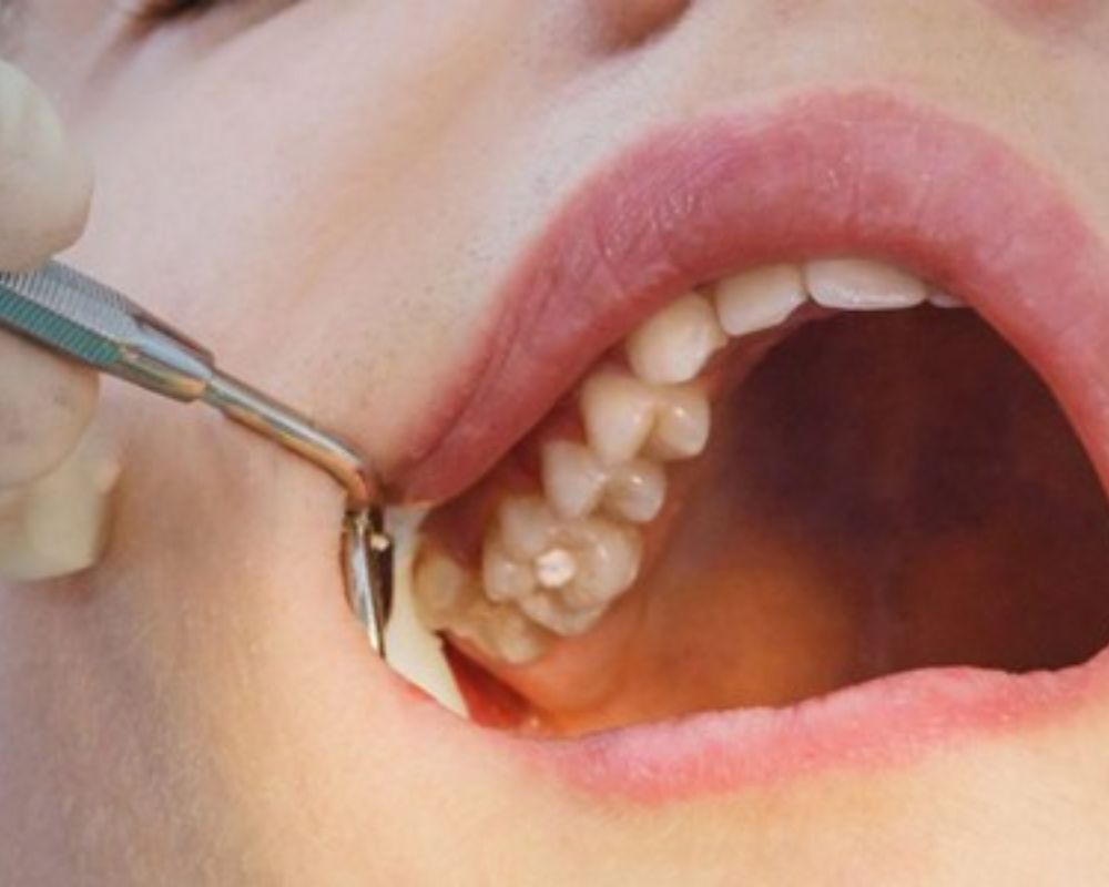 Quy trình nhổ răng khôn
